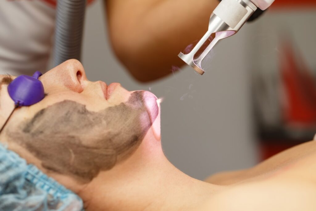 Carbon Peel
