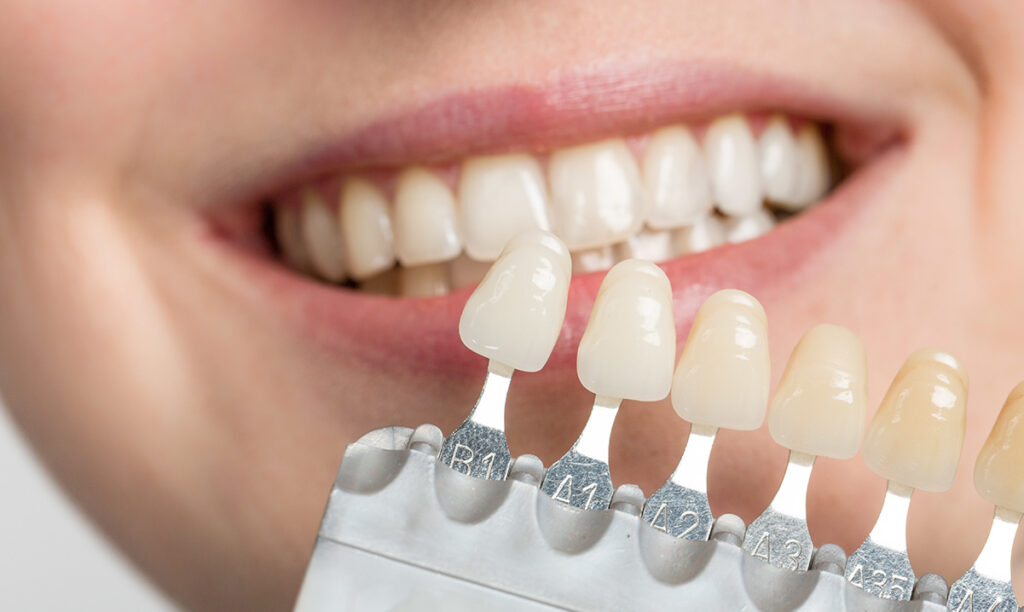 veneer procedure step by step