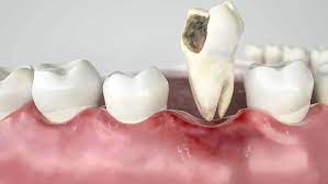 broken tooth extraction procedure