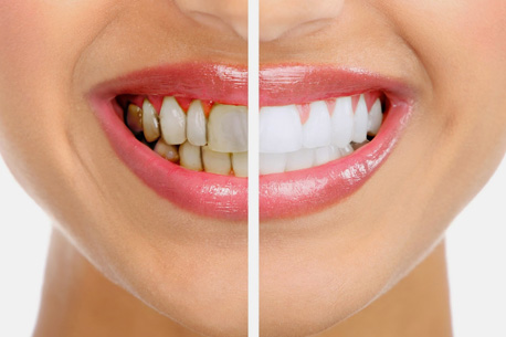 teeth whitening home remedies