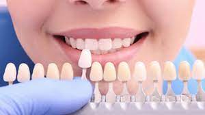 veneers dentist near me in Houston TX