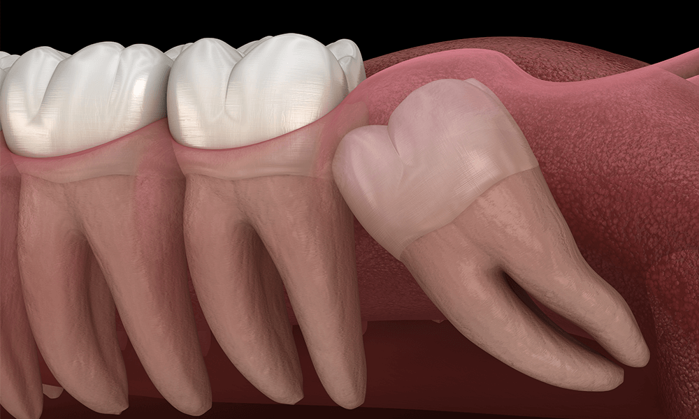 wisdom tooth removal cost
