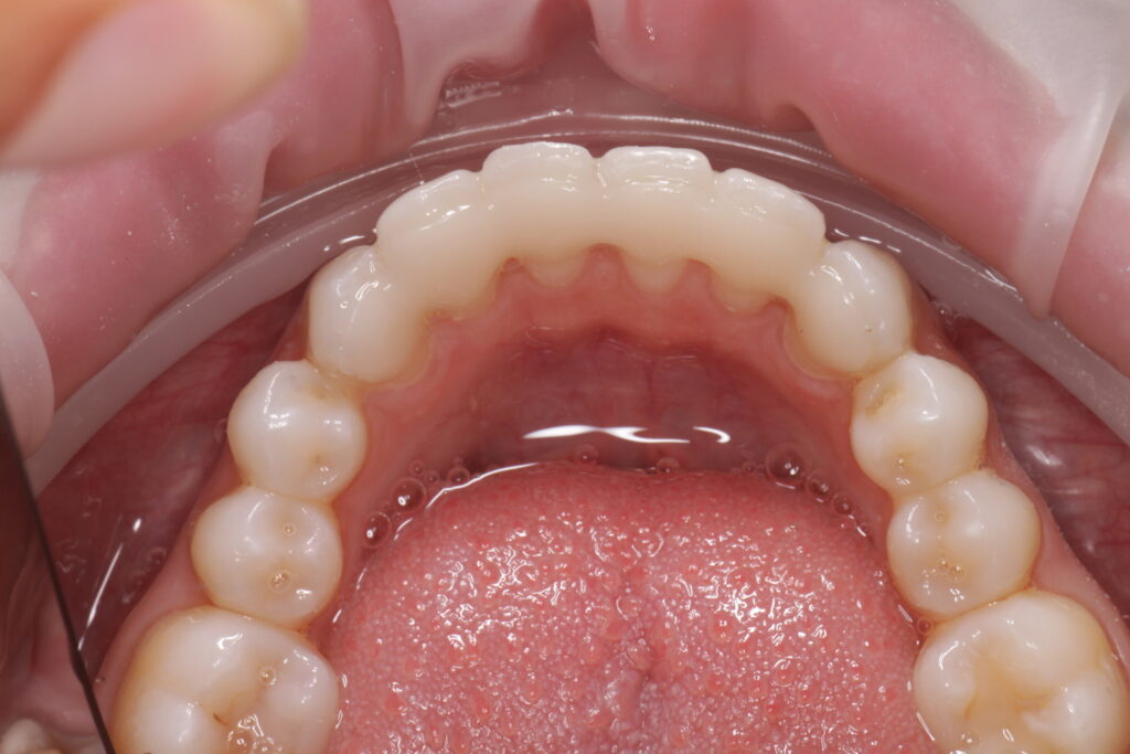 permanent retainer broke
