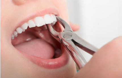 tooth extraction near me