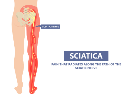 Sciatica: Causes, Symptoms, and Treatment - safe4cure