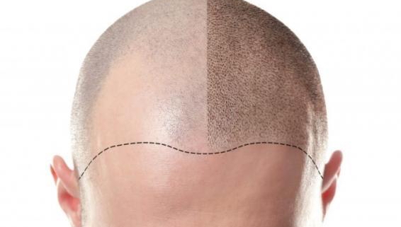 Title: Discover Excellence in FUE Hair Transplants at a Top Los Angeles Clinic