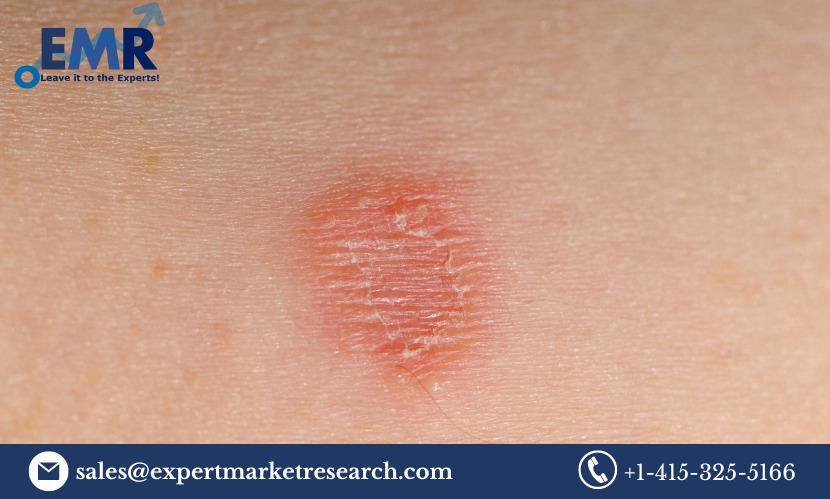 Tinea Corporis Treatment Market