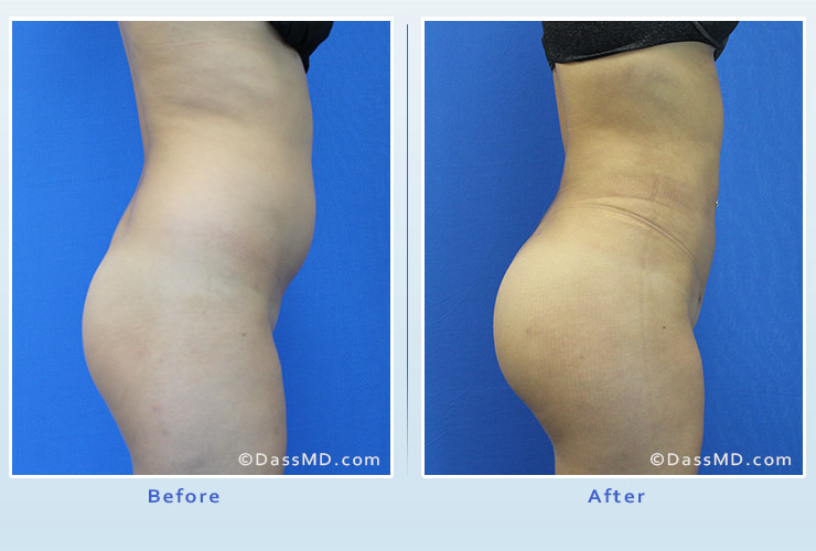 brazilian butt lift before and after