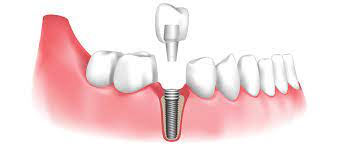 Dental implants in Aberdeen