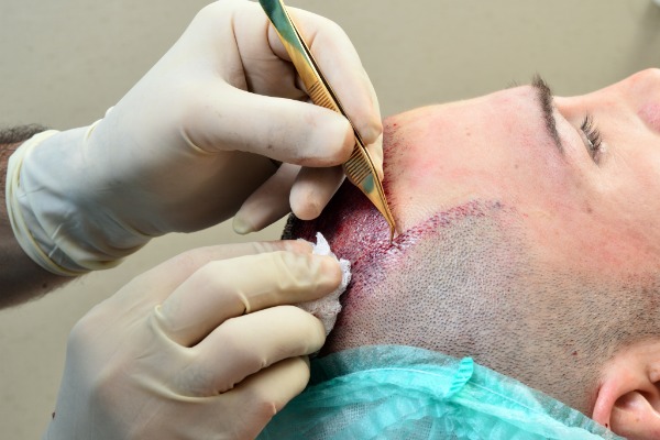 Experience Luxury Hair Restoration in Beverly Hills, CA