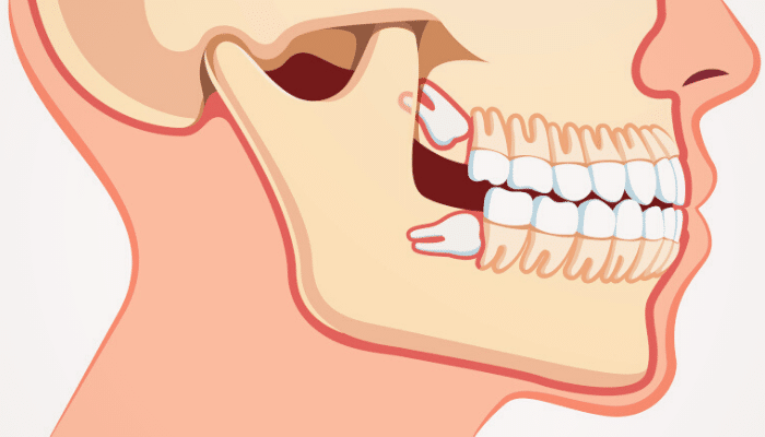 wisdom tooth pain symptoms