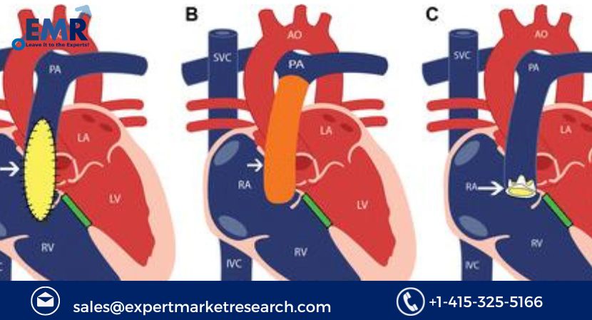 Transcatheter Pulmonary Valve Market