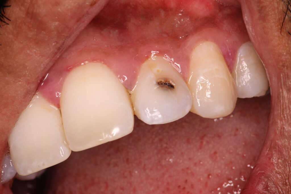 cavities on front teeth