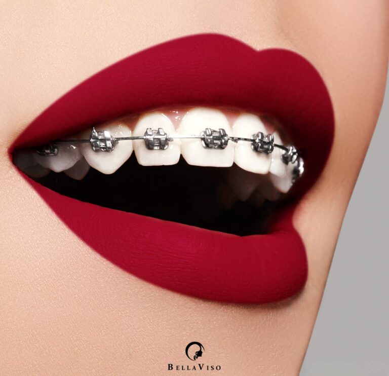Affordable Braces in Dubai