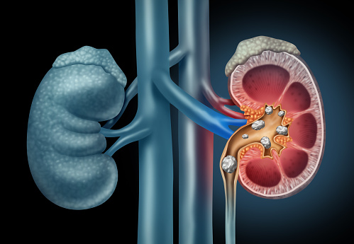 kidney stone removal near me