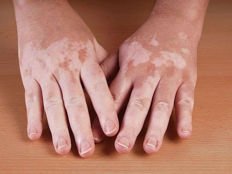 treatment for vitiligo